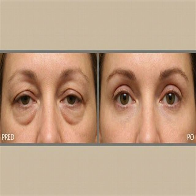 Blefaroplastika pred a po – výsledok operácie viečok